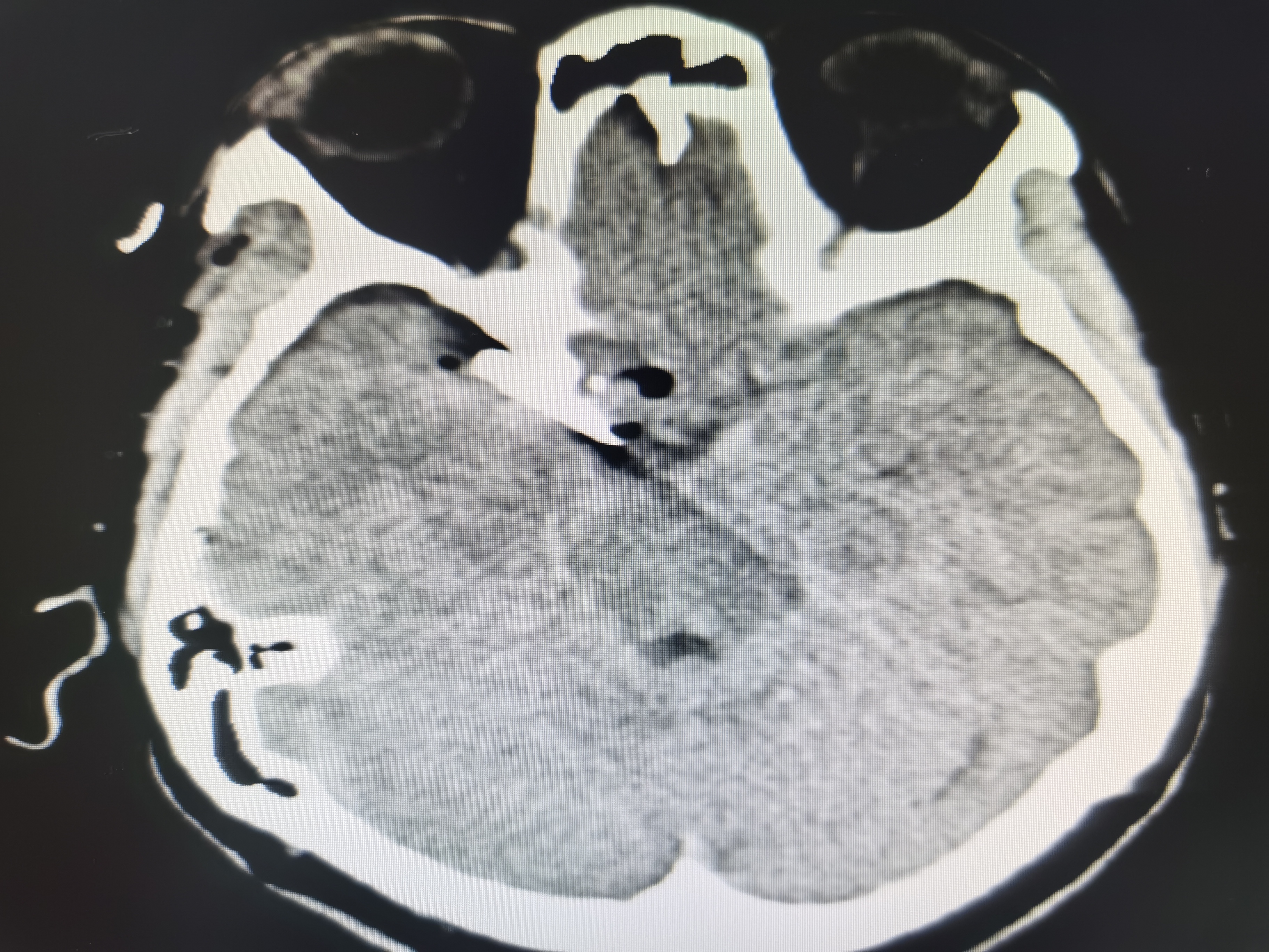 术后2小时复查头颅CT，无新发出血、脑梗塞发生。.jpg