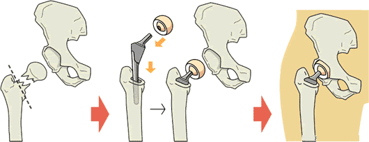 10髋关节置换流程.png