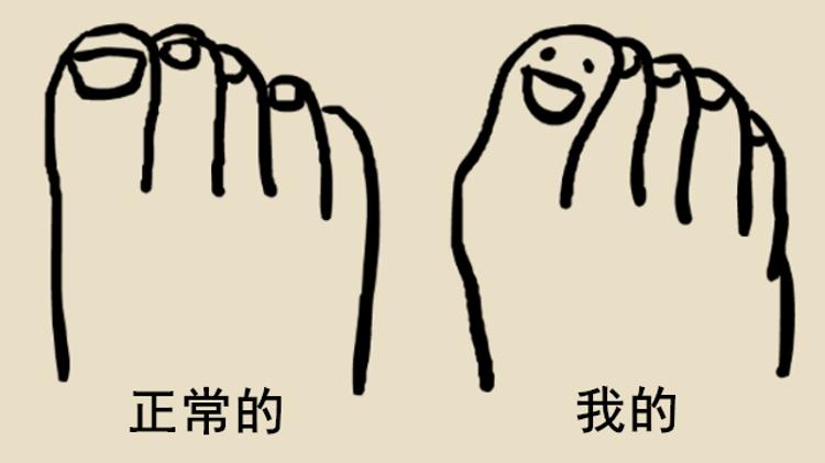 科普 | 没想到穿鞋过紧 还会导致大拇趾歪了？